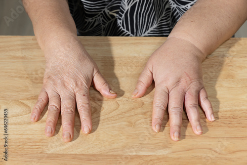 Cancer chemotherapy cause swelling hand , skin to become dry, dark or peel and nails brittle or flaky. photo