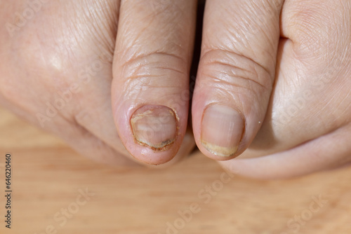 Cancer chemotherapy cause nails brittle or flaky. photo