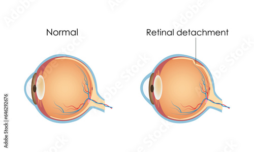 Retinal detachment, eye disease, Flat vector illustration medicine