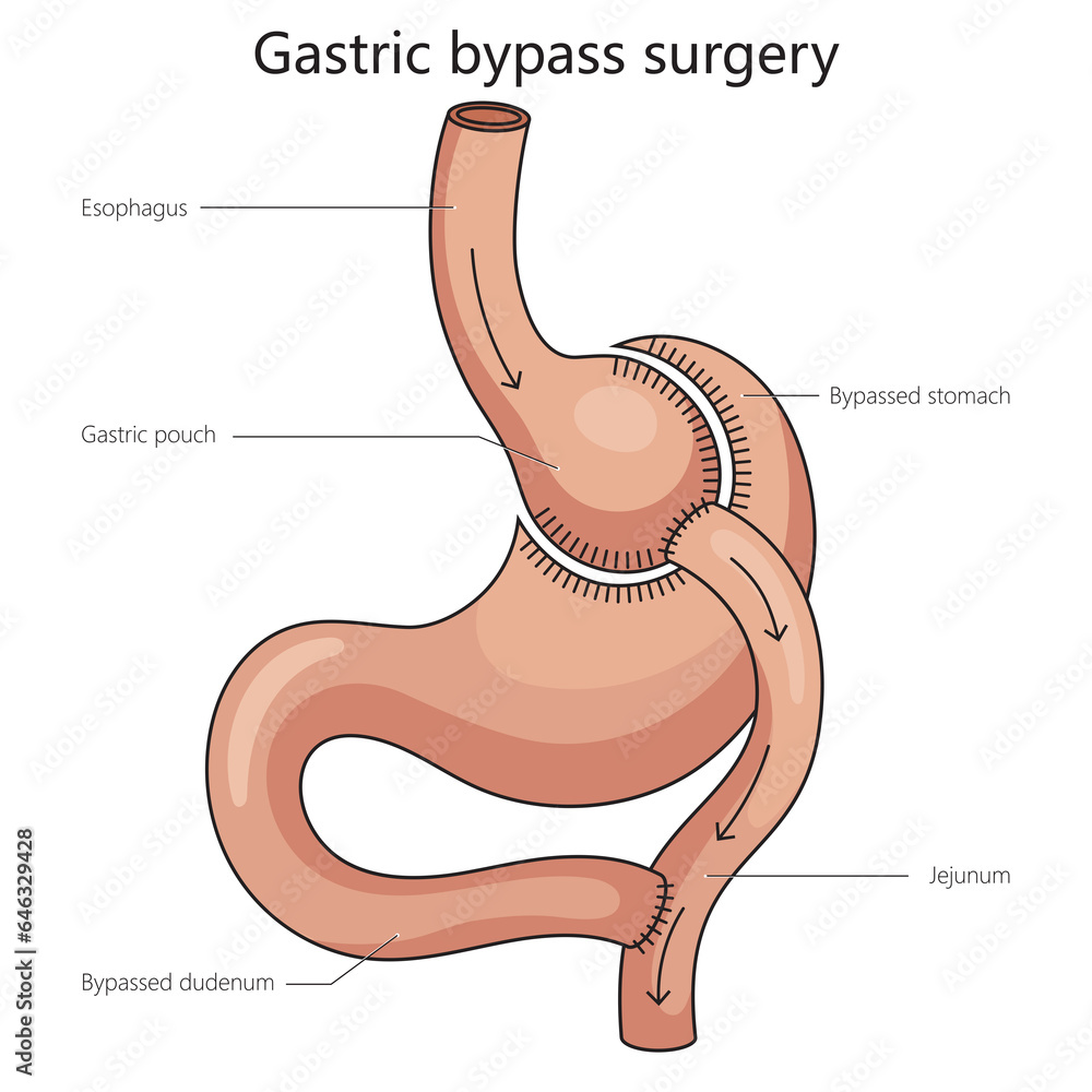 Gastric bypass surgery stomach is divided diagram schematic raster illustration. Medical science educational illustration - obrazy, fototapety, plakaty 