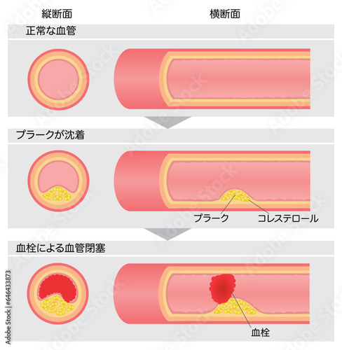 進行する動脈硬化の縦横断面図の比較説明イラスト