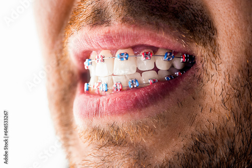 Man braces. Teeth braces on the white teeth of man to equalize the teeth. Bracket system in smiling mouth, macro photo teeth, close-up lips, macro shot, dentist photo