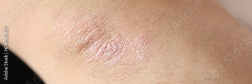 Damaged, dry itchy skin on elbow area close-up.