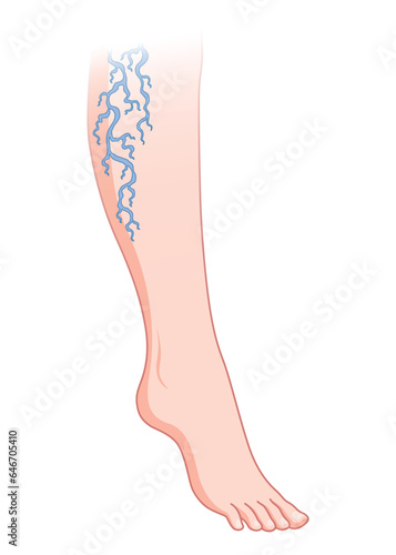 Varicose veins. Blue blood vessel visible through the skin, abnormally swollen leg. Vascular disease diagnostic and treatment. Venous insufficiency medical disease