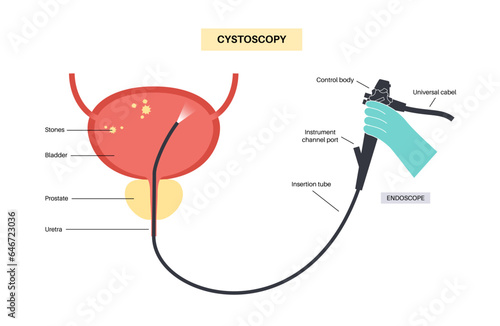 Cystoscopy examination concept