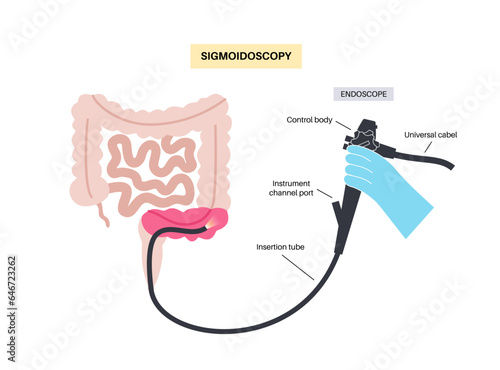 Sigmoidoscopy medical procedure