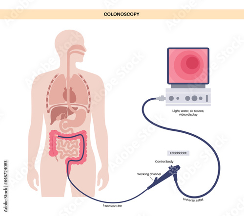 Colonoscopy medical procedure