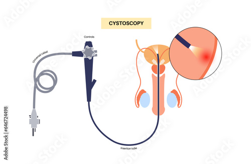 Cystoscopy examination concept