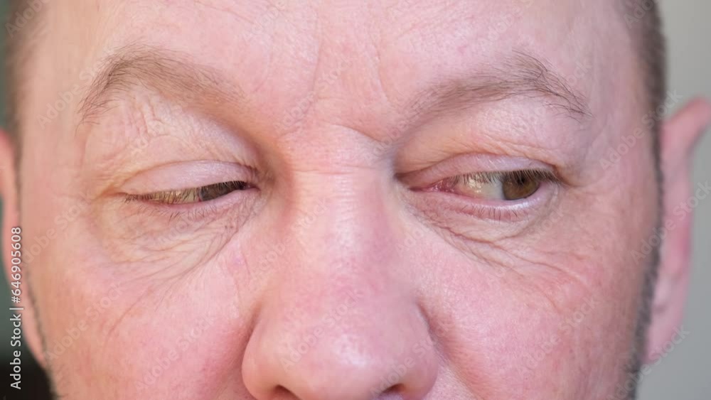 Blood in the eye of a broken blood vessels. Blood pressure. Injury. The eyeball injury from a blow. The adult man looking at the camera and rolling eyes. Impact of stress and fatigue on a human body. Blood in the eye of a broken blood vessels. Blood pressure. Injury. The eyeball injury from a blow. The adult man looking at the camera and rolling eyes. Impact of stress and fatigue on a human body.