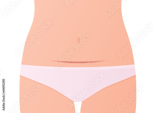 woman belly with a scar from a cesarean section - vector illustration