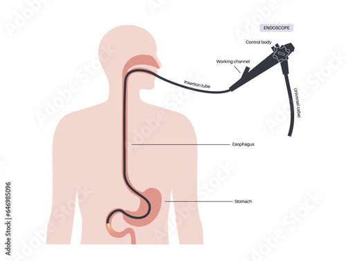 esophagogastroduodenoscopy medical procedure