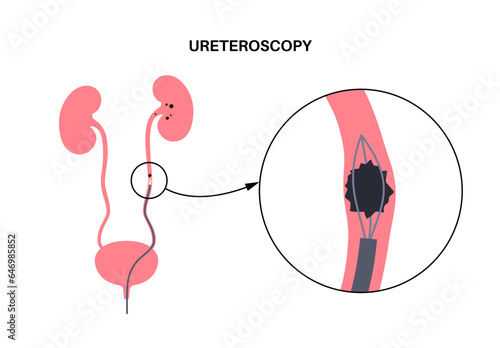 Ureteroscopy medical poster