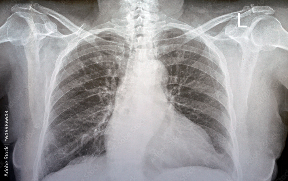 Plain x ray chest of an old woman with almost normal study of bones ...