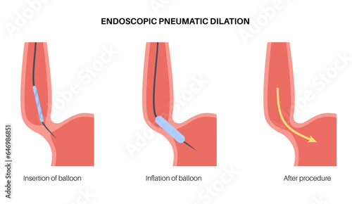 Endoscopic pneumatic dilation