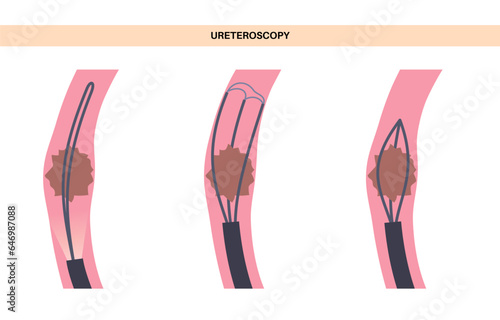 Ureteroscopy medical poster