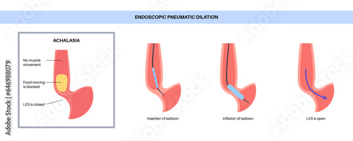 Endoscopic pneumatic dilation