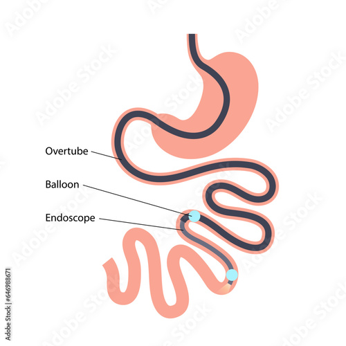 Double balloon enteroscopy