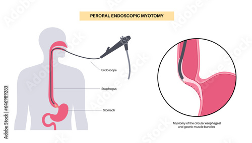 POEM medical poster