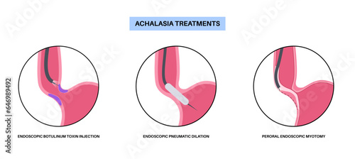 Achalasia treatments procedures