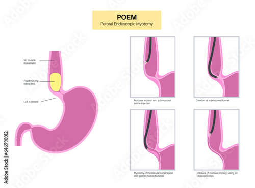 POEM medical poster