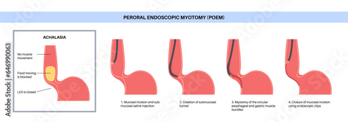 POEM medical poster