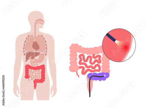 Sigmoidoscopy medical procedure
