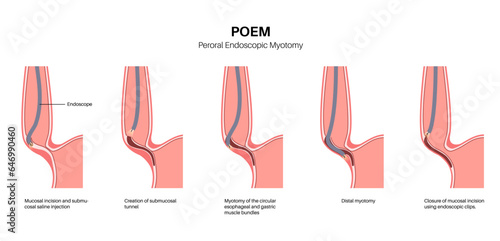 POEM medical poster photo