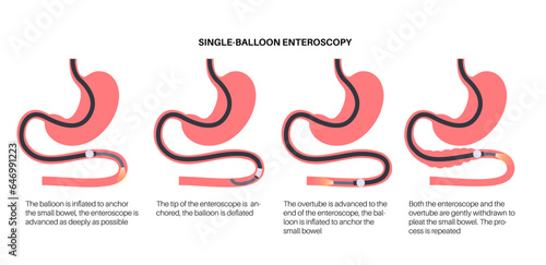 Single balloon enteroscopy
