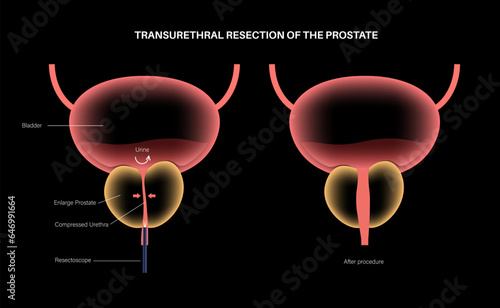 Transurethral resection of the prostate