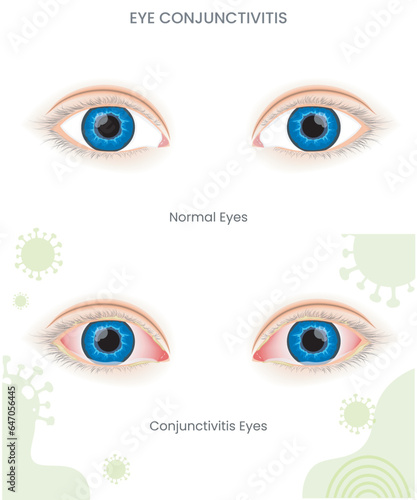 During Pink eye or eye conjunctivitis it shows Eye membrane inflammation, redness, irritation, and discharge