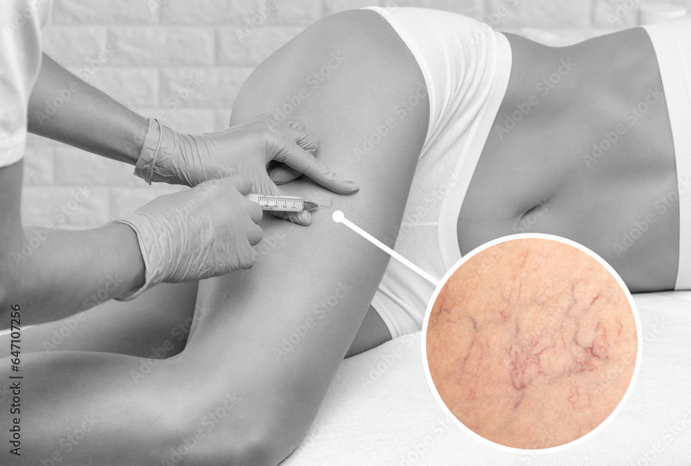 Removal of varicose veins on the legs. Medical inspection and treatment of Telangiectasia. Phlebeurysm. Removal of varicose veins on the legs. Medical inspection and treatment of Telangiectasia. Phlebeurysm.