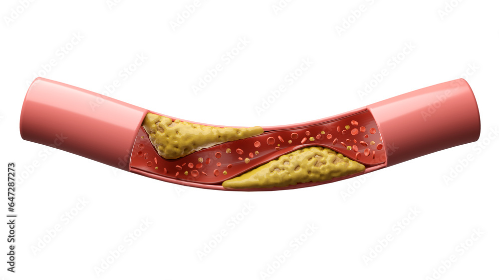 Hyperlipidemia or high cholesterol in blood vessel isolated white background - obrazy, fototapety, plakaty 