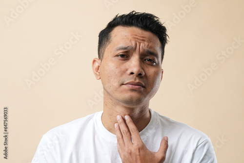 A Photo of Acne and pores on the face of a young Asian man. Improper therapy has led to a form of inflammation face and isolated on a cream background.
