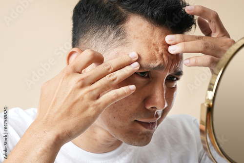 Photo of Asian teenage boy upset with problem skin squeezes pimple in front of a small round mirror.