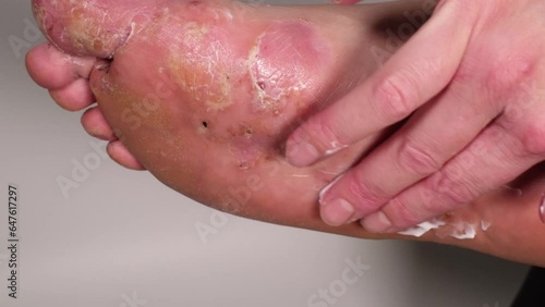Woman applying steroid or cortisol creme on her foot. Medical treatment of eczema, acute psoriasis, allergic inflammation, dermatological disease. Huge wound on female toes after blisters of eczema. photo