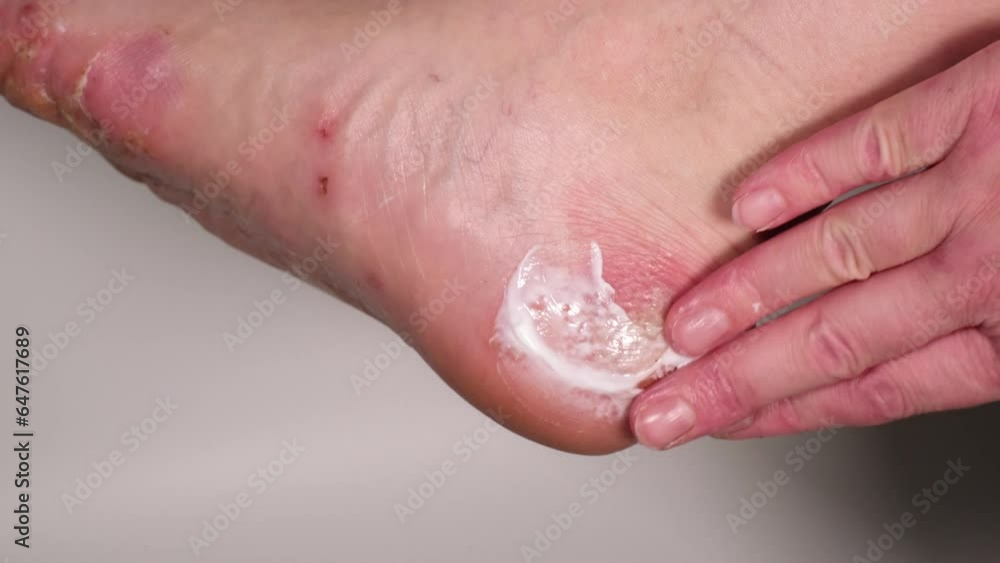 Woman applying steroid or cortisol creme on her foot. Medical treatment
