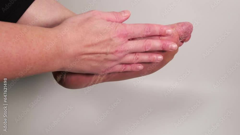 Woman checking her sole with her finger. Many wounds on female foot after several confluent blisters of eczema. Acute psoriasis, chemical irritation, allergic reaction, dermatological disease on foot. Woman checking her sole with her finger. Many wounds on female foot after several confluent blisters of eczema. Acute psoriasis, chemical irritation, allergic reaction, dermatological disease on foot.
