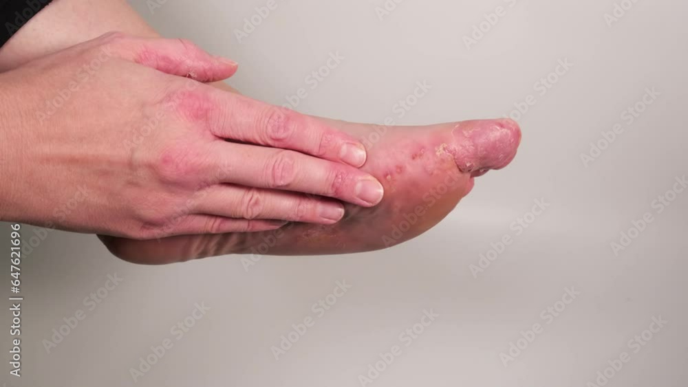 Woman rubbing and scratching her sole with her finger. Itchy red wounds on female foot after several confluent blisters of eczema. Acute psoriasis, allergic reaction, dermatological disease on foot. Woman rubbing and scratching her sole with her finger. Itchy red wounds on female foot after several confluent blisters of eczema. Acute psoriasis, allergic reaction, dermatological disease on foot.