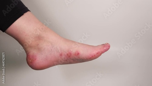 Woman showing her damaged foot. Red inflamed wounds on female skin after several confluent blisters of eczema. Acute psoriasis, chemical irritation, allergic reaction, dermatological disease. photo
