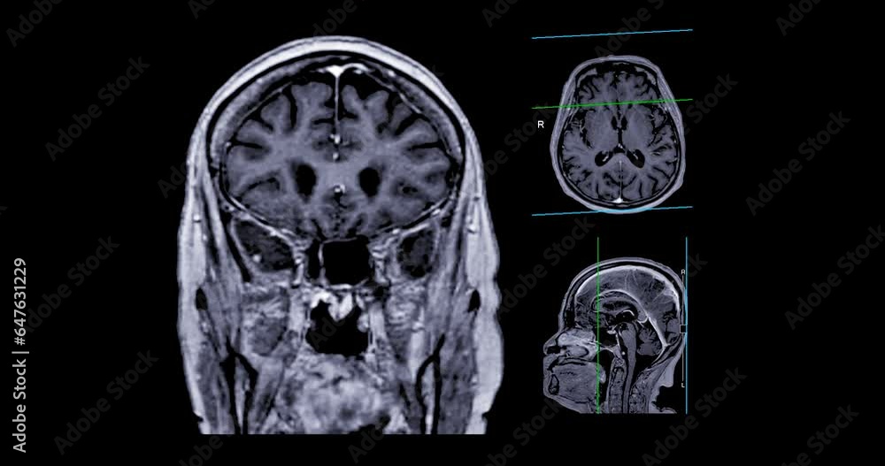 MRI Brain with reference line can help doctors look for conditions such as bleeding, swelling, tumors, infections, inflammation, damage from an injury or a stroke diseases.