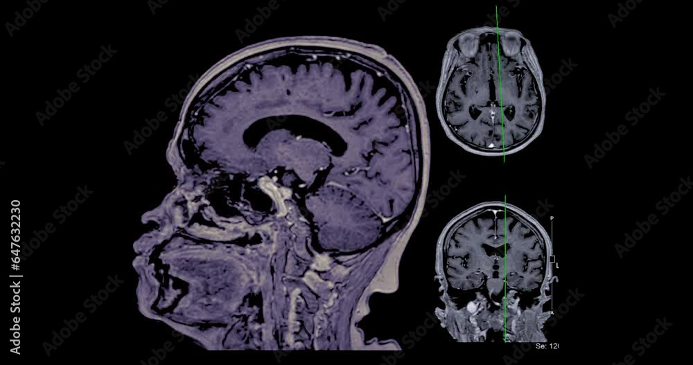 MRI Brain with reference line can help doctors look for conditions such as bleeding, swelling