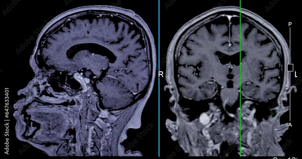 MRI Brain with reference line can help doctors look for conditions such as bleeding, swelling