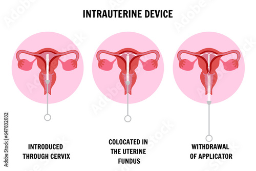Intrauterine device located 