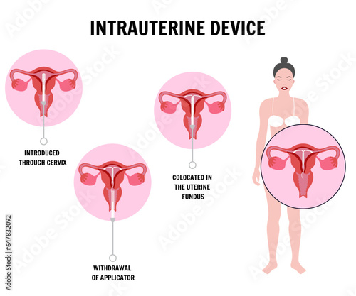 Intrauterine device located 