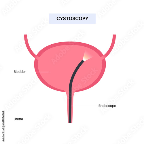 Cystoscopy examination concept