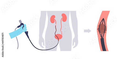 Ureteroscopy medical poster
