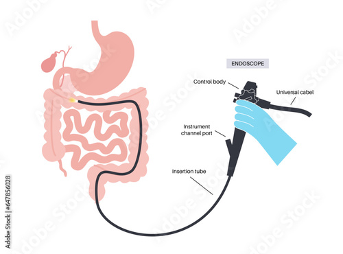 Colonoscopy medical procedure