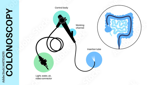 Colonoscopy medical procedure
