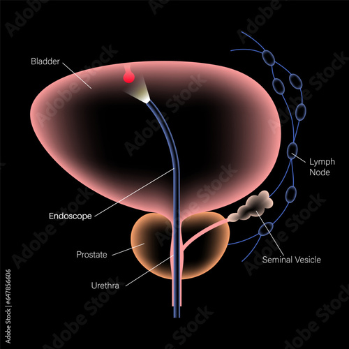 Cystoscopy examination concept