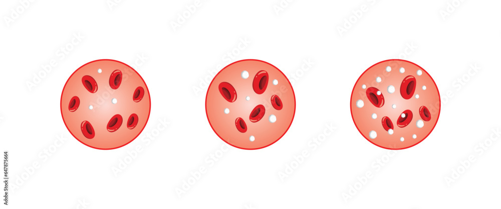 Leukopenia and Leukocytosis Concept Design. Vector Illustration. Leukopenia and Leukocytosis Concept Design. Vector Illustration.